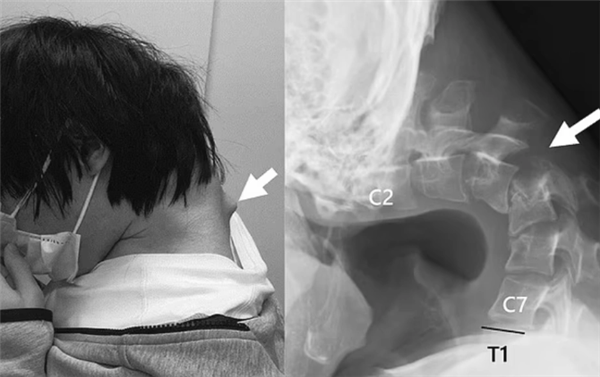 365体育唯一入口：日本25岁男子沉迷手游致脖子长角：无法抬起头出现吞咽困难(图1)